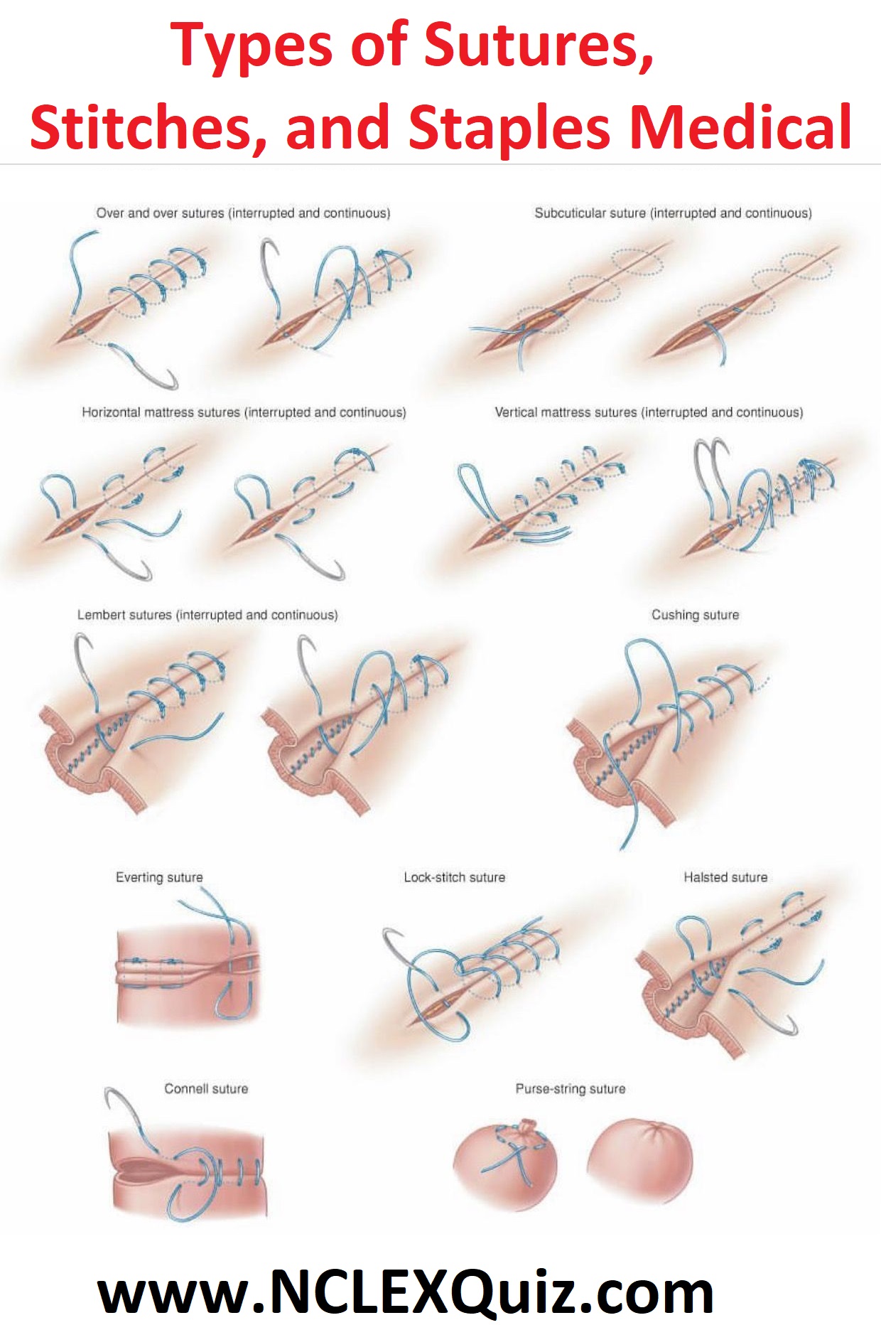 staples versus sutures