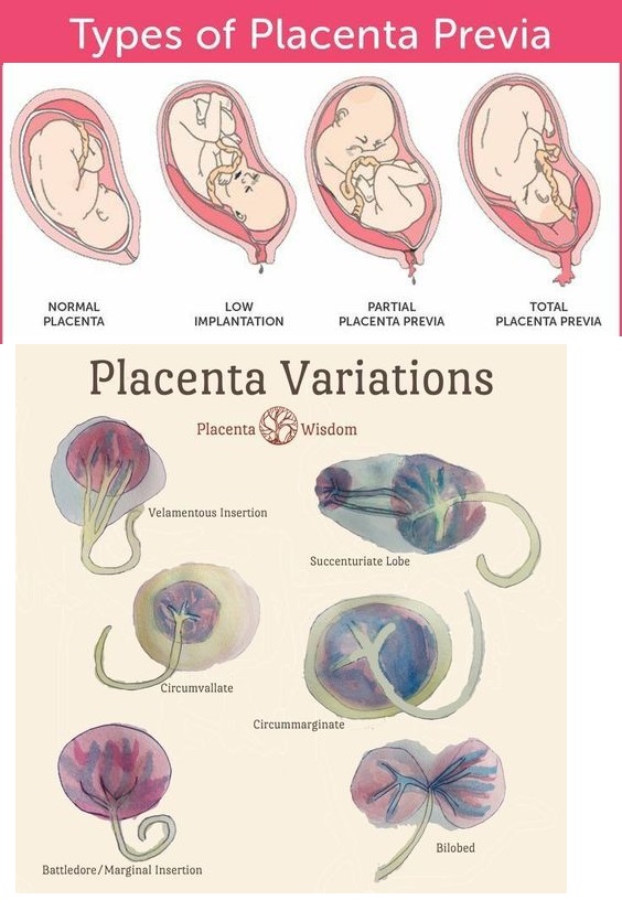 types of placenta presentation