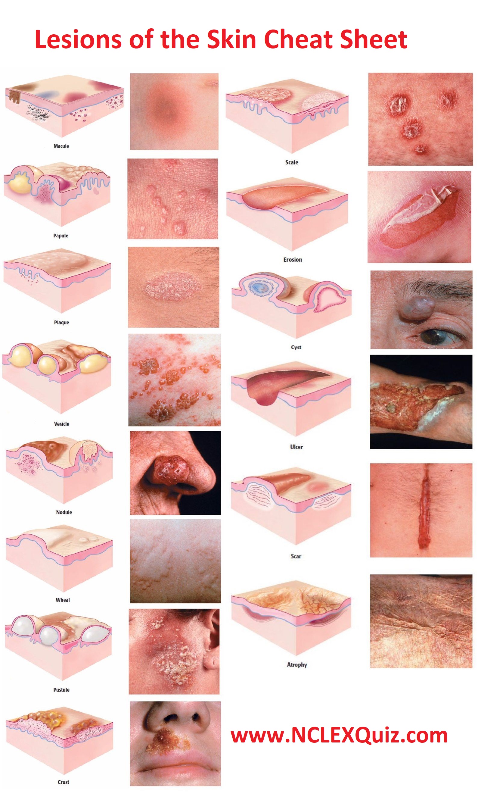 Nursing Dermatology Lesions Of The Skin Cheat Sheet 