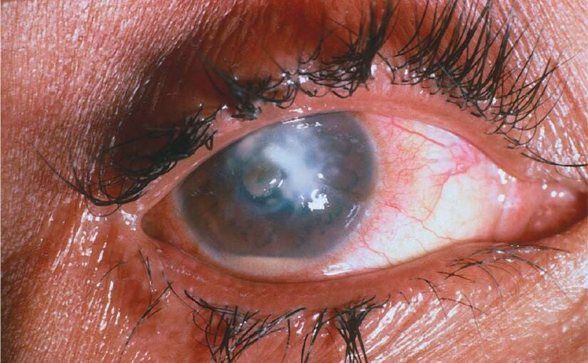 Effective Eye Management: A NCLEX Practice Question on Dry and Irritated Cornea