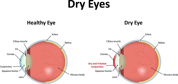 Effective Eye Management: A NCLEX Practice Question on Dry and Irritated Cornea