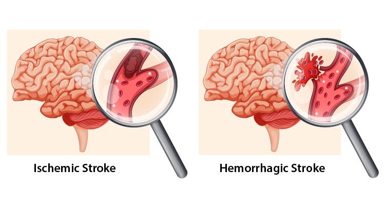 Nursing Actions for Hemorrhagic Stroke Patients